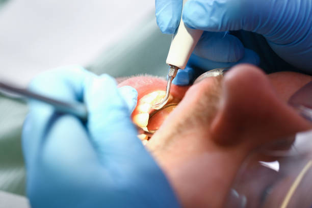 Best Emergency Dentist for Lost Fillings or Crowns in New Boston, OH